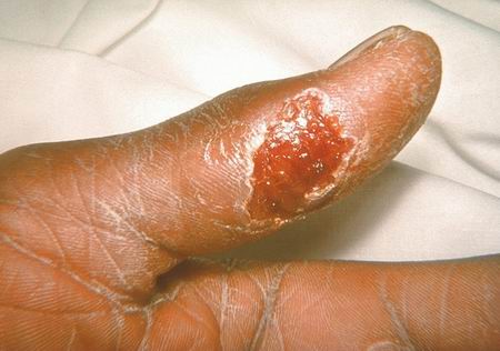 Tularemia