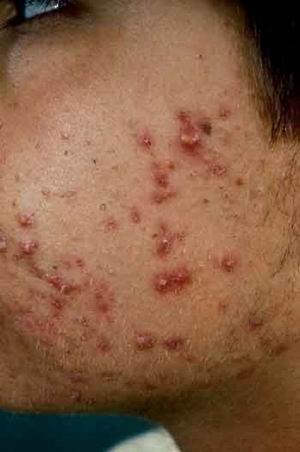 Acne