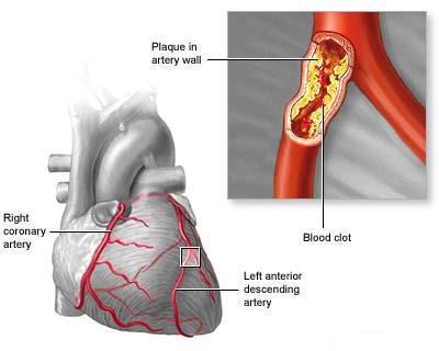 Acute Coronary Syndrome
