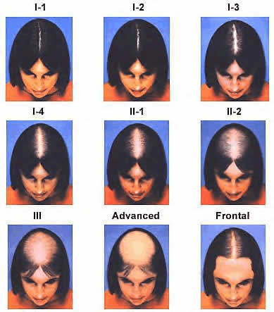 Alopecia