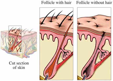 Alopecia