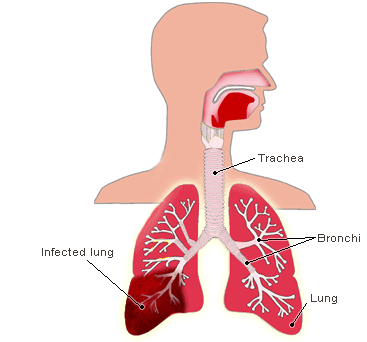 Aspiration pneumonia