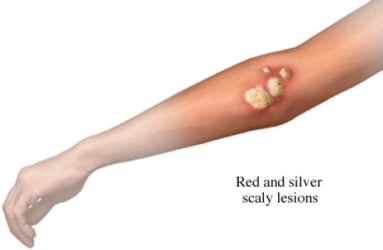 Atopic dermatitis