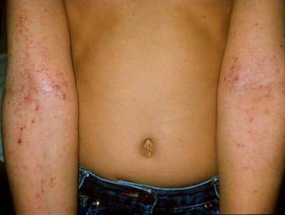Atopic dermatitis