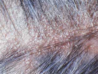 Dandruff