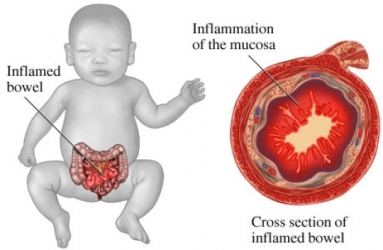 Enterocolitis