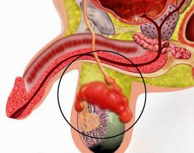 Epididymitis