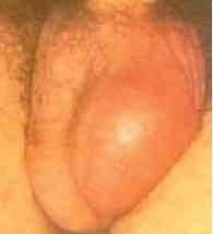 Epididymitis