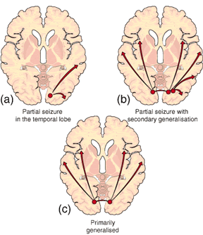 Epilepsy