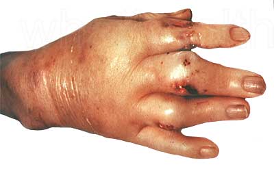 Gout