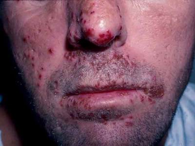 Herpes simplex