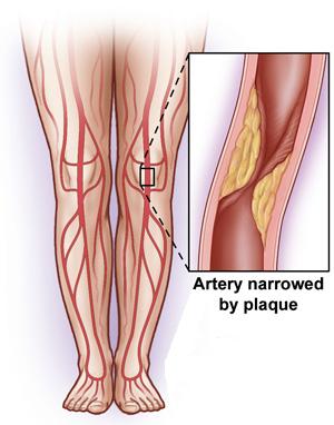 Intermittent claudication
