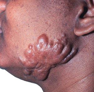 Keloids