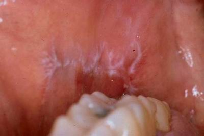 Lichen planus