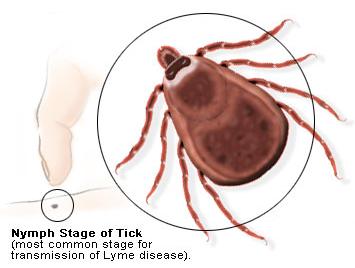 Lyme disease