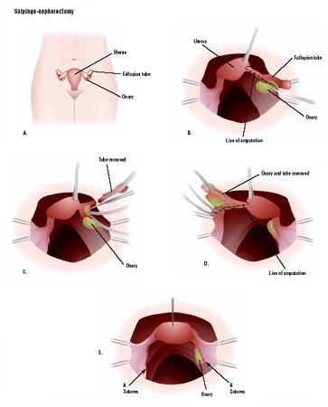 Oophorectomy