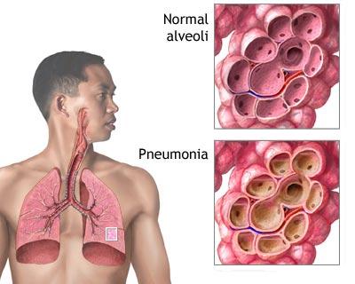 Pneumonia