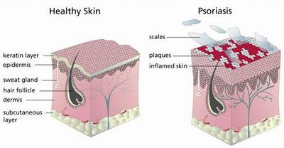 Psoriasis