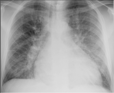 Pulmonary edema