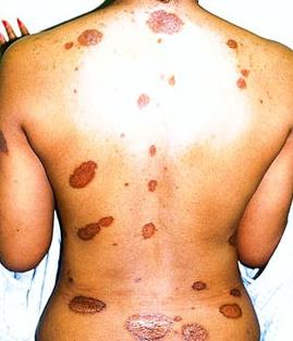 Sarcoidosis
