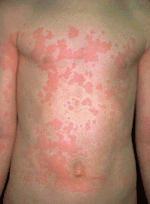 Urticaria